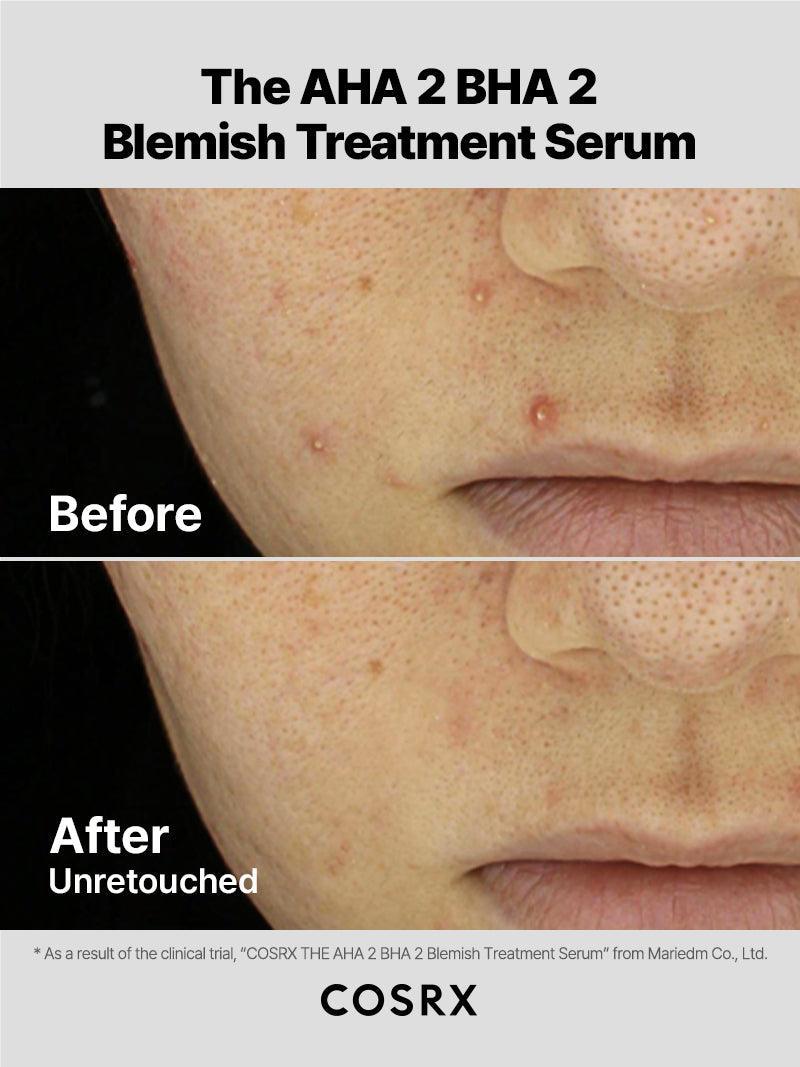 COSRX The AHA 2 BHA 2 Blemish Treatment 50g